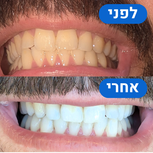 ערכת הלבנה היחידה בישראל לחיוך לבן ובריא - כבר מהיום הראשון