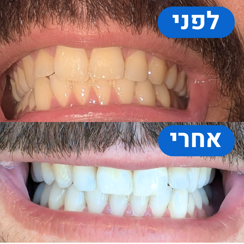 ערכת הלבנה היחידה בישראל לחיוך לבן ובריא - כבר מהיום הראשון