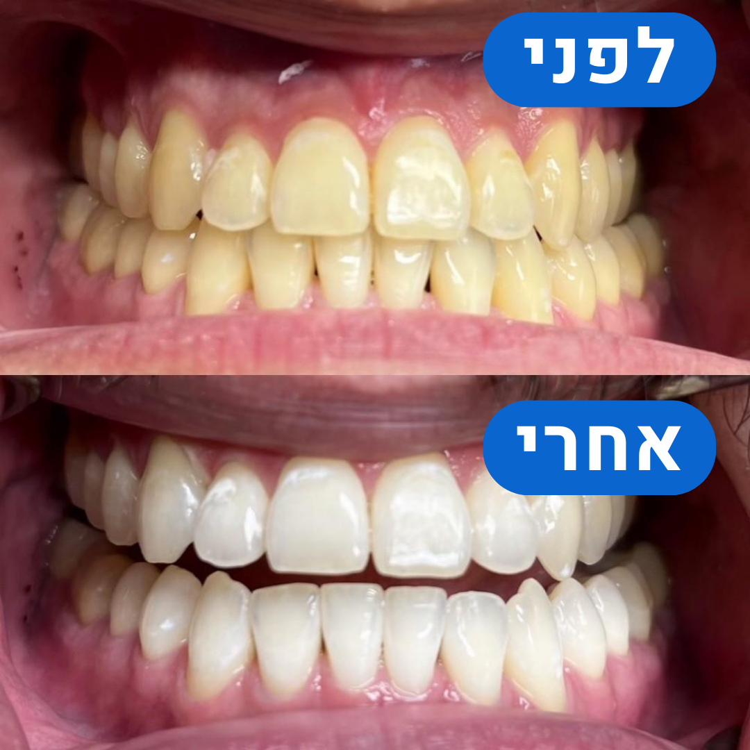 ערכת הלבנה היחידה בישראל לחיוך לבן ובריא - כבר מהיום הראשון