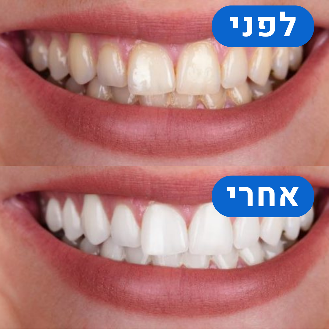 ערכת הלבנה היחידה בישראל לחיוך לבן ובריא - כבר מהיום הראשון