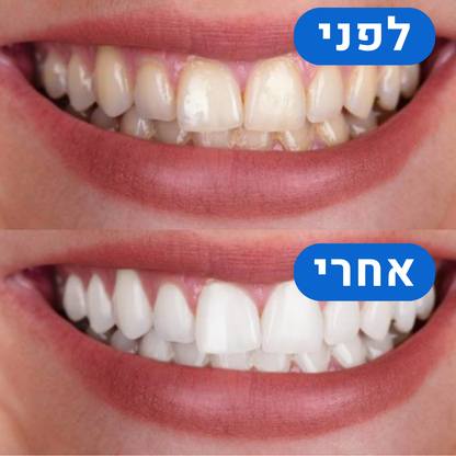 ערכת הלבנה היחידה בישראל לחיוך לבן ובריא - כבר מהיום הראשון