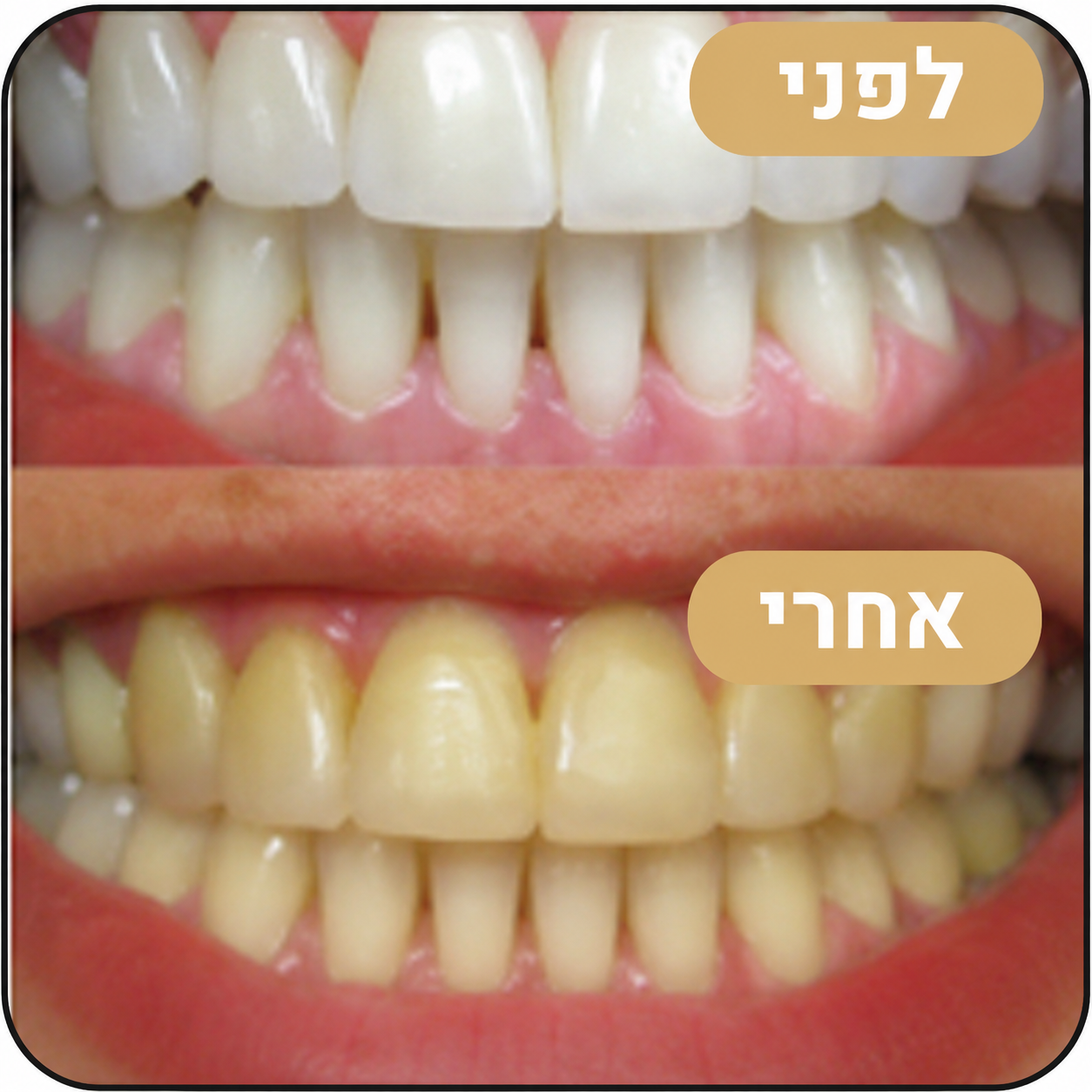 מארז ההלבנה Miswak - הלבנה טבעית ללא כימיקלים כבר מהשימוש הראשון