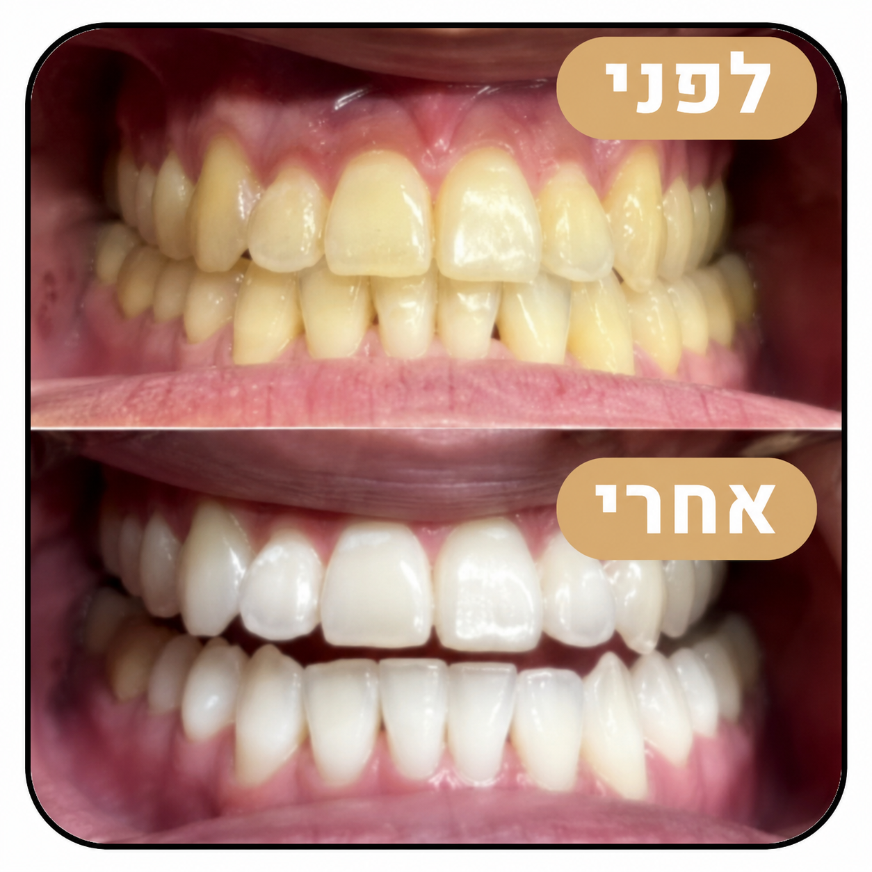 מארז ההלבנה Miswak - הלבנה טבעית ללא כימיקלים כבר מהשימוש הראשון
