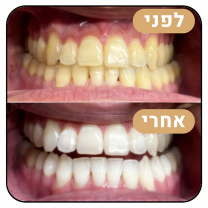 מארז ההלבנה Miswak - הלבנה טבעית ללא כימיקלים כבר מהשימוש הראשון